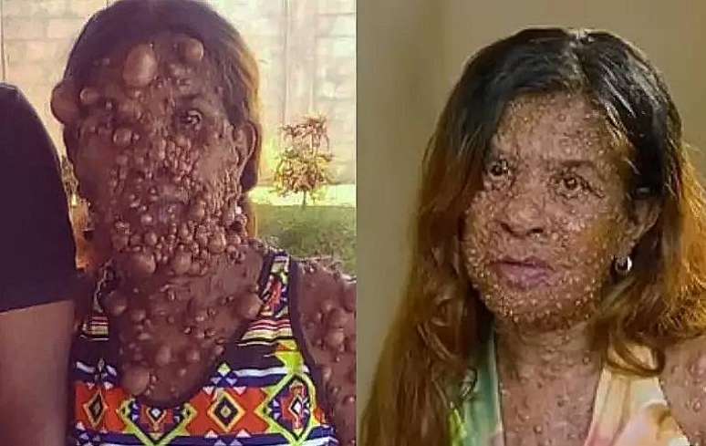 Charmaine Sahadeo antes e depois da cirurgia para retirada dos tumores
