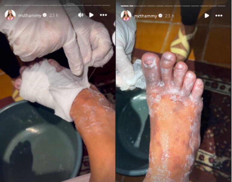MC Thammy compartilhou imagens do seu pé e como está sendo o tratamento