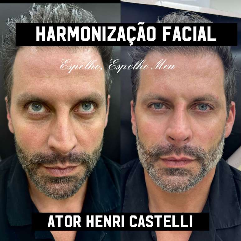 Henri Castelli realiza harmonização facial; confira o resultado
