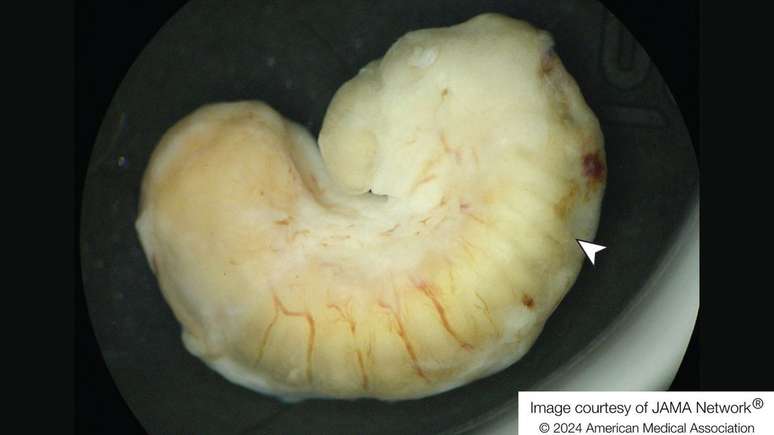 Parasita retirado do olho de uma paciente que comeu carne de crocodilo (Imagem: Van Acker et al, 2024/JAMA Ophthalmology)