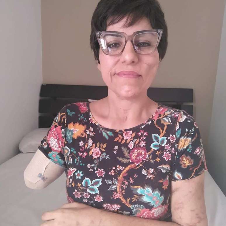 A cabeleireira teve o bra&ccedil;o direito amputado e precisou ficar 28 dias hospitalizada