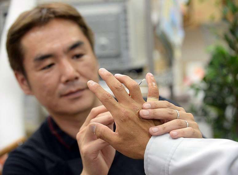 Muitos ex-membros da yakuza que praticavam yubitsume reconstroem seus dedinhos com próteses para se reintegrarem à sociedade japonesa, onde um dedo decepado carrega um forte estigma