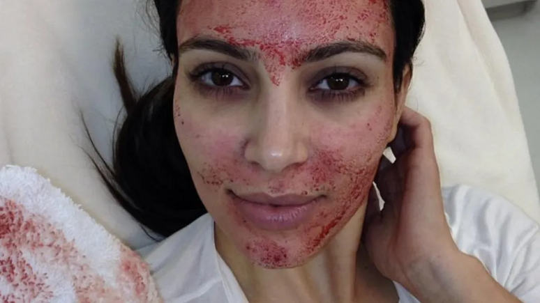 Kim Kardashian postou uma foto depois de receber um vampire facial em 2013