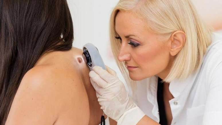 É importante detectar a tempo a alterações suspeitas na pele no caso de melanoma