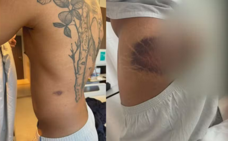 Imagens mostram os hematomas de Danilo, que ficou 6 dias internado