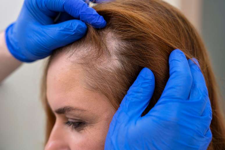 Is hair loss hereditary?  Myths and truths on the subject