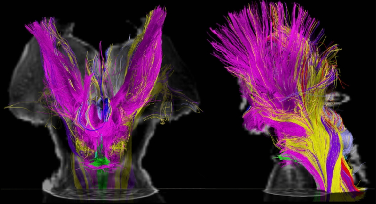 Rede que se ramifica a partir do tronco cerebral e que pode estar ligada à vigília na consciência humana (Imagem: Edlow et al./Science Translational Medicine)