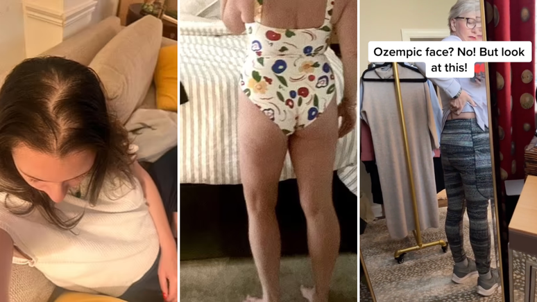 "Bunda de Ozempic" e queda de cabelo: mulheres relatam efeitos colaterais