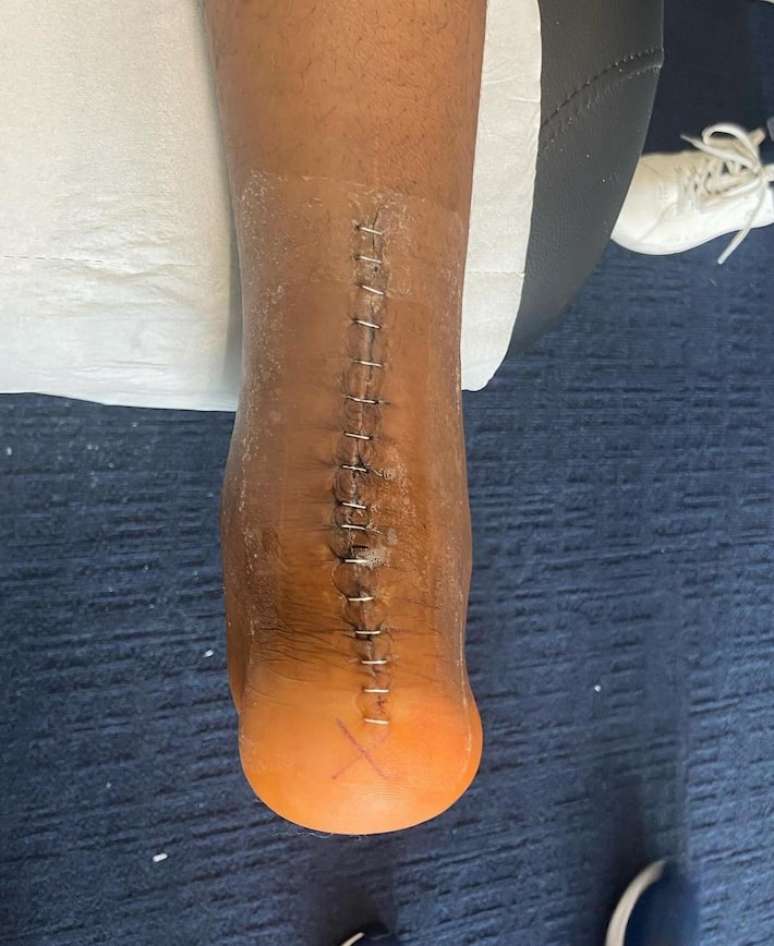 Kimpembe mostra cicatriz de cirurgia no tendão de Aquiles.