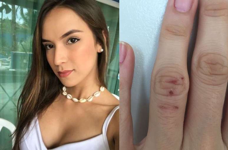 Katherine Bermudes ficou com o dedo machucado após o assalto