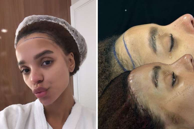 Brunna Gon&ccedil;alvez faz frontoplastia |