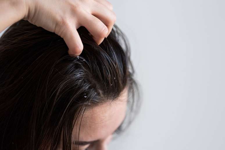La enfermedad puede provocar la caída del cabello.