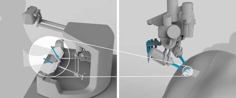 Robô da Sony foi desenvolvida para realizar microcirurgias e pode "costurar" um grão de milho (Imagem: Reprodução/Sony)
