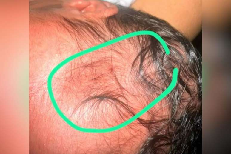 Uma bebê recém-nascida foi atingida de raspão na cabeça por uma bala perdida dentro da ala pediátrica do Hospital Barão de Lucena