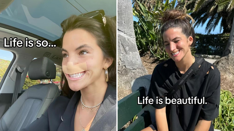 Jovem que teve lábio e parte do nariz arrancados por cachorro comemora recuperação: ‘A vida é linda’