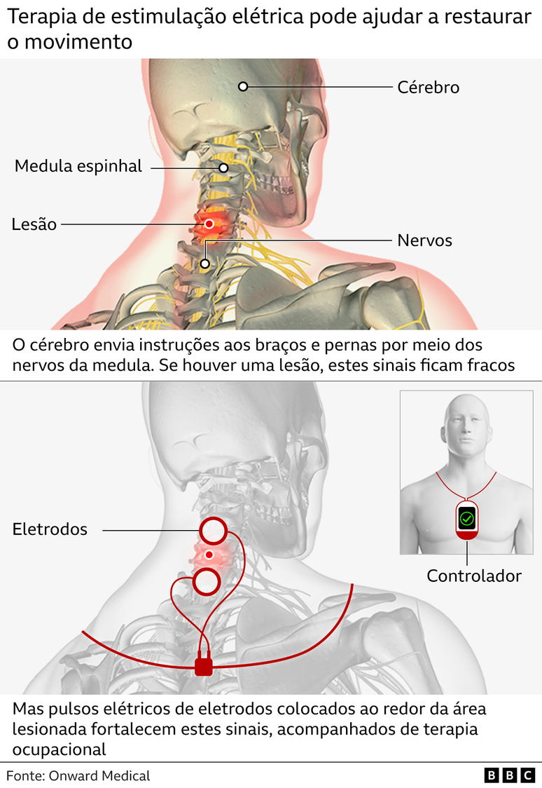 Infográfico mostra como funciona a terapia