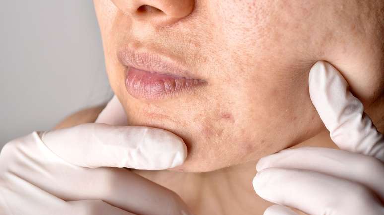 Teve acne depois dos 40? Conheça mais sobre as causas e tratamento da acne da mulher adulta
