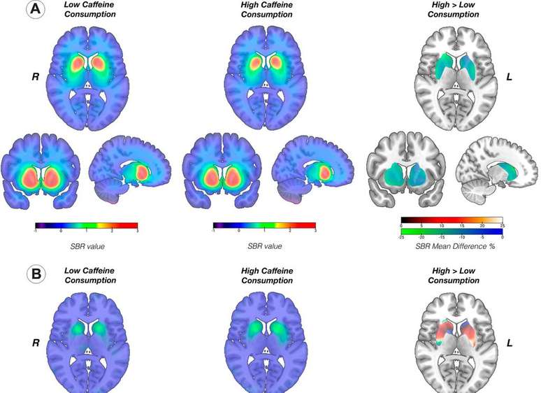 Changes in the brain of a Parkinson's patient who consumes too little caffeine (left) and too much caffeine (middle) (Image: Kaasinen et al, 2024)