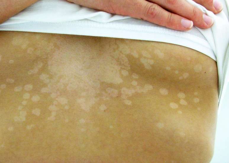 White cloth on the skin: learn about Pityriasis Versicolor (or beach mycosis)