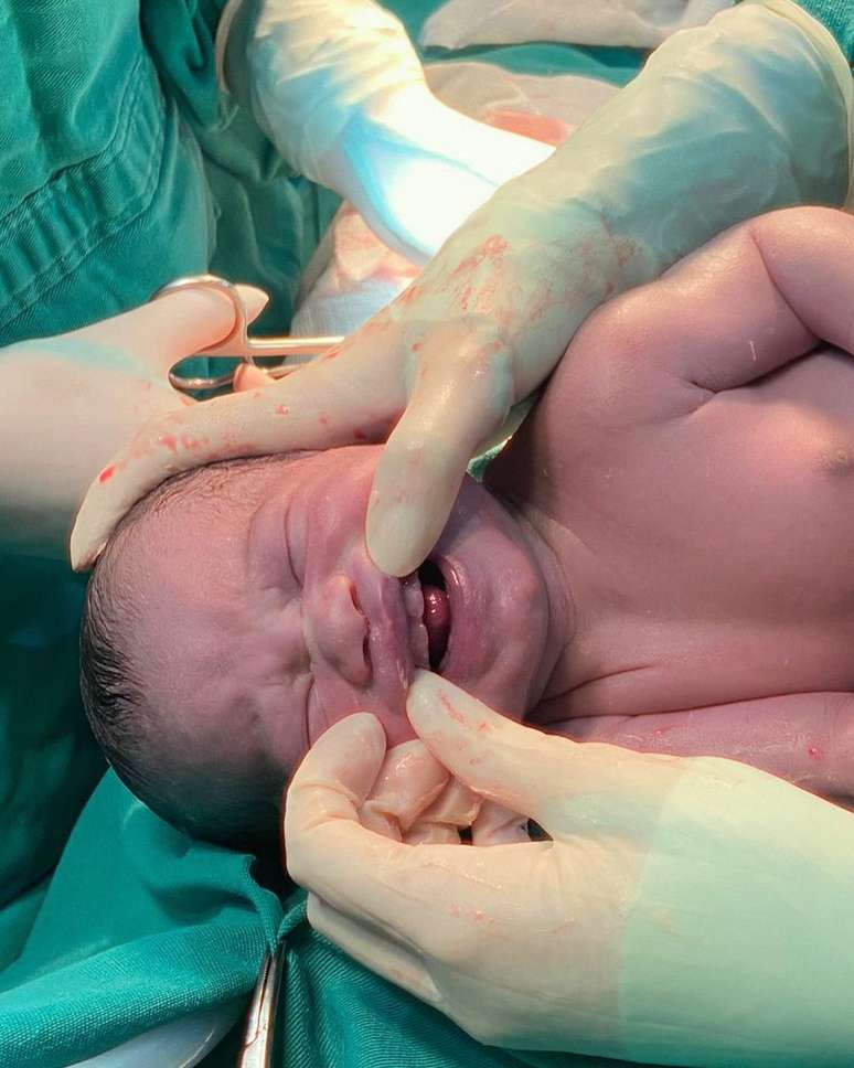 O pequeno Arthur nasceu com alguns dentes e surpreendeu equipe médica