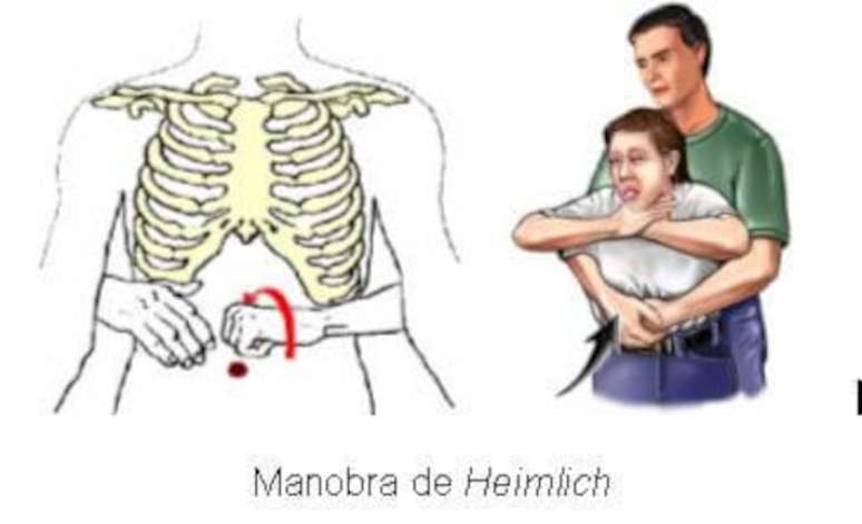 Heimlich maneuver for choking children: knowing when and how to perform it