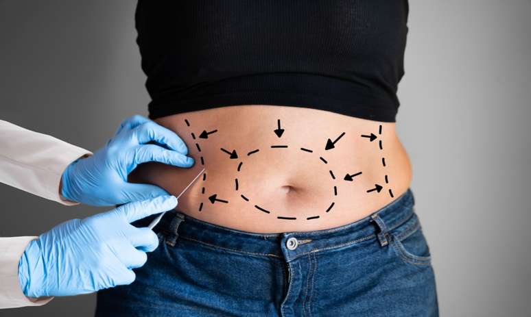 Cirurgião plástico responde 5 dúvidas sobre a abdominoplastia