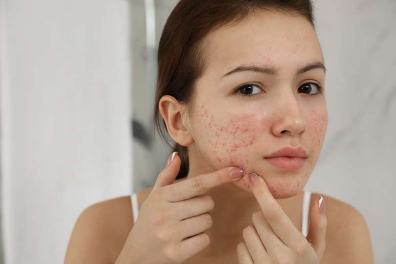Dermatologista recomenda algumas dicas para tratar esses problemas na pele /
