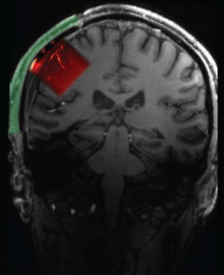 Implante transparente de crânio é usado em paciente para estudar o cérebro (Imagem: Divulgação/Caltech)