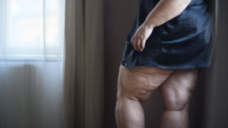 Lipedema