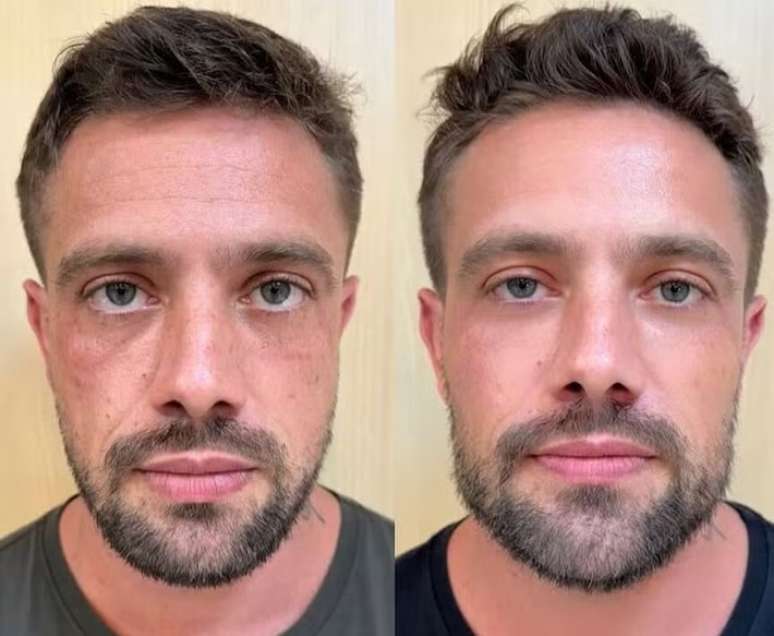 Rafael Cardoso mostra resultado de harmonização facial.