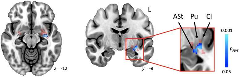 Studi mengungkapkan wilayah otak yang berhubungan dengan asal usul kegagapan (Gambar: Theys et al., 2024/Brain)