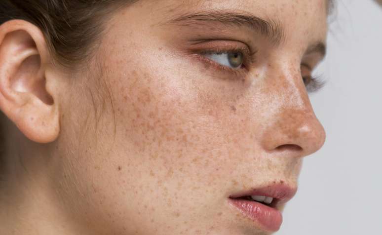 Veja quais alimentos podem amenizar o melasma