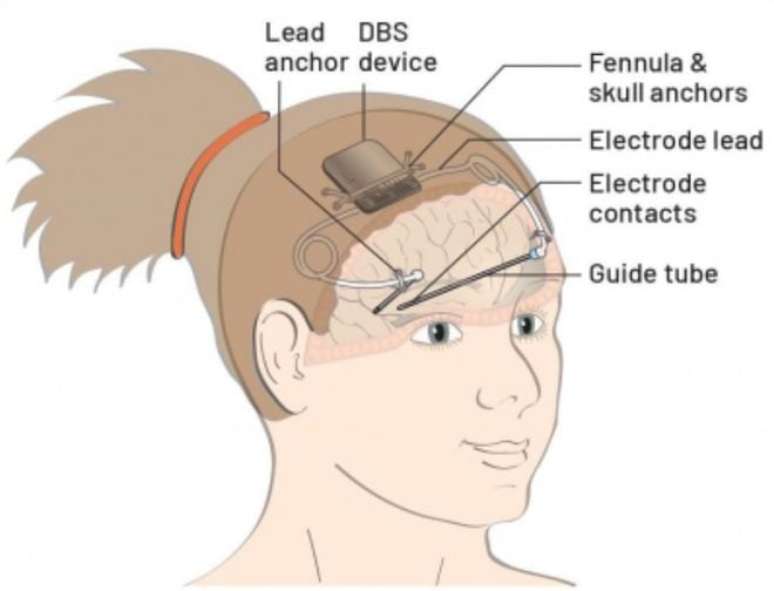 Implante cerebral reduz 80% das crises de epilepsia em menino britânico, que é o primeiro a conviver com o dispositivo (Imagem: Reprodução/Projeto CADET/UCL)