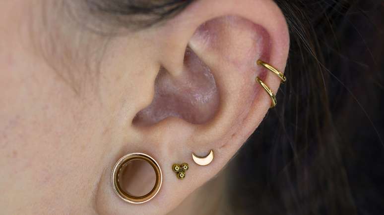 Alargador de orelha pode causar deformidades permanentes que exigem intervenção cirúrgica