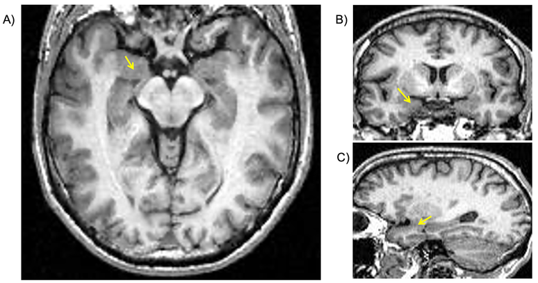 Localização da amígdala em imagens de ressonância magnética (indicadas pelas setas amarelas). A) plano axial; B) plano coronal e C) plano sagital