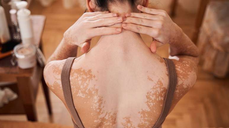 Algumas doenças de pele podem ser provocadas por questões emocionais