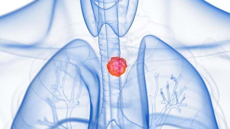 Fazer quimioterapia antes e depois de uma cirurgia amplia sobrevida de pacientes com tumor no esôfago