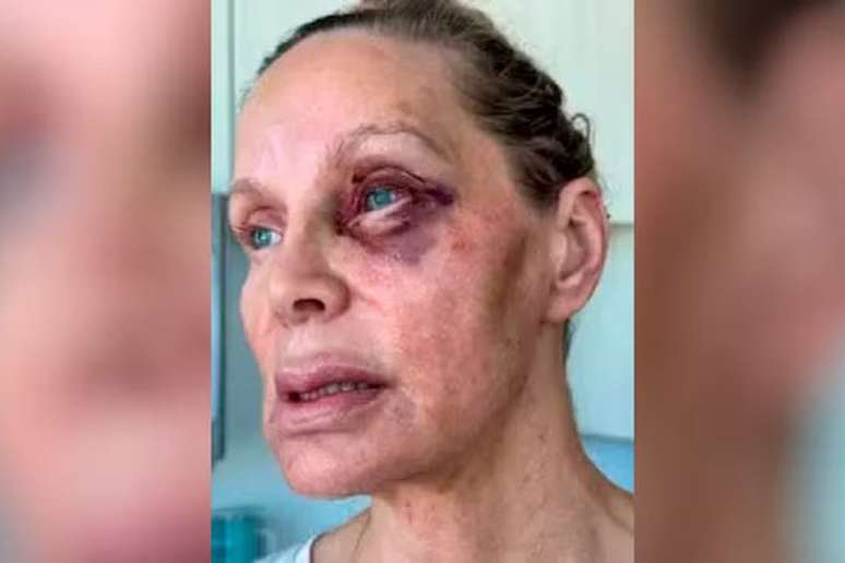 Christina Fulton mostrou ferimentos após ser agredida pelo filho, Weston Cage