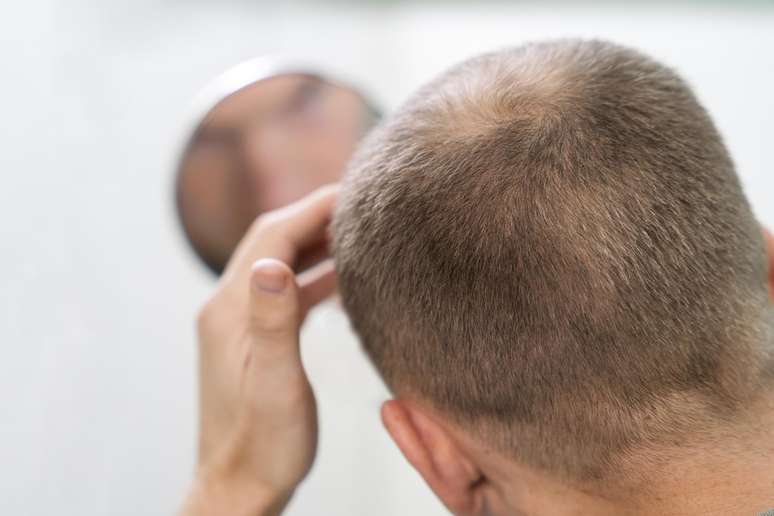 A queda de cabelo pode ser favorecida desde fatores genéticos até questões hormonais e ambientais