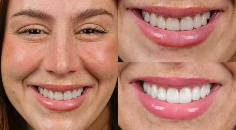 Reparos foram feitos para harmonizar a falta do incisivo lateral do lado esquerdo