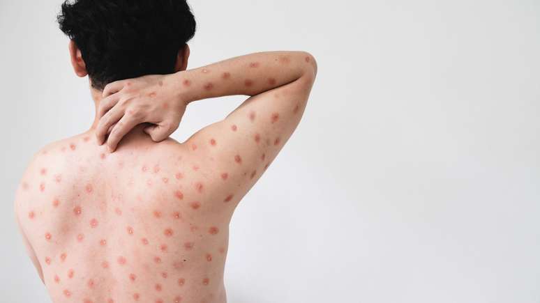 A mpox é uma doença zoonótica viral