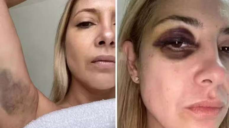 A ex-primeira-dama Fabíola Yañez mostra hematomas no braço e olho roxo