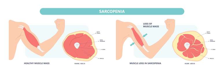 Um diagrama mostra como a massa muscular pode diminuir com a sarcopenia.