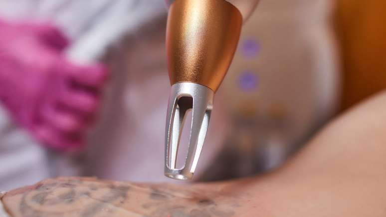 Do you regret your tattoo? Find out how laser hair removal works