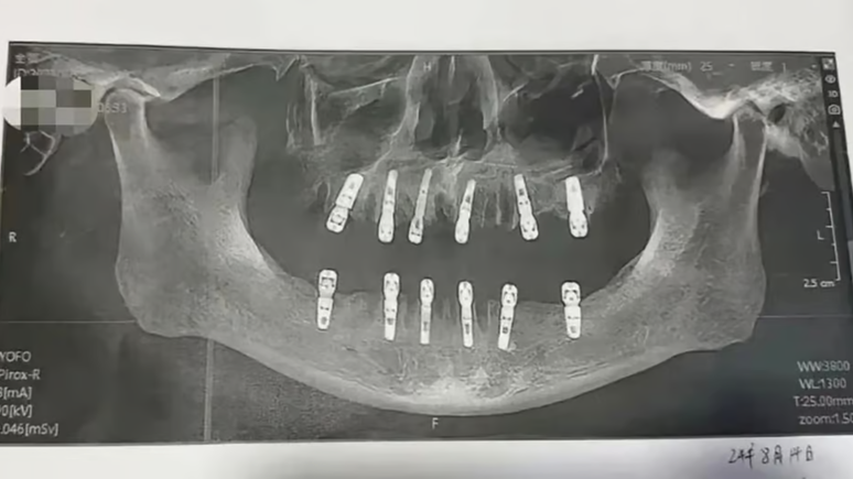 Homem morre após extrair 23 dentes e implantar outros 12 no mesmo dia