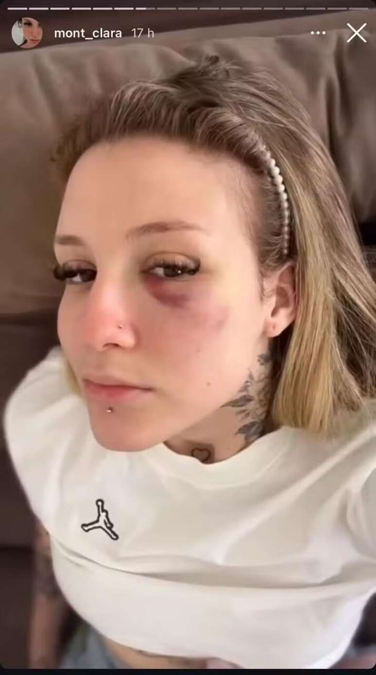 Clara registrou em imagens os hematomas oriundos das agressões