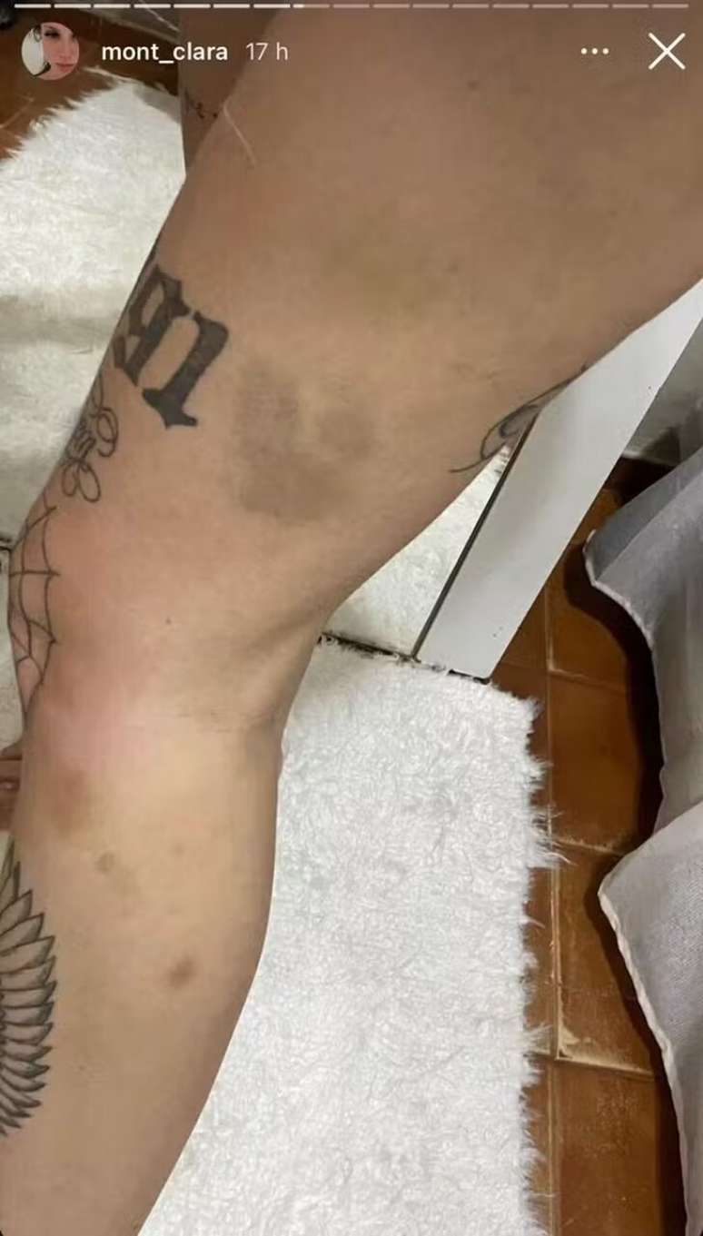 Tatuador mostra um hematoma na perna –