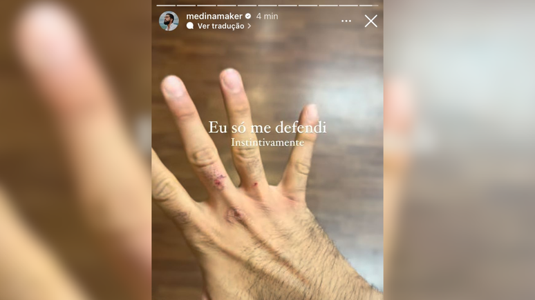 Em seu perfil nas redes sociais, Medina postou uma foto da mão ferida pelo soco e afirma que apenas se defendeu: “Instintivamente”.