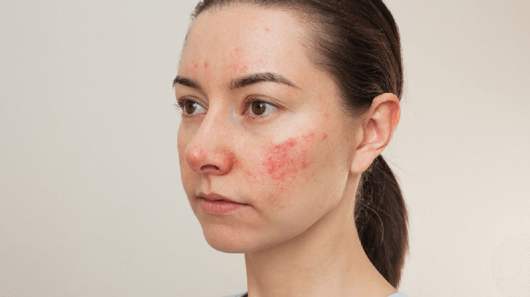 A convivência com altos níveis de estresse podem influenciar no agravamento da acne / Foto: Shutterstock