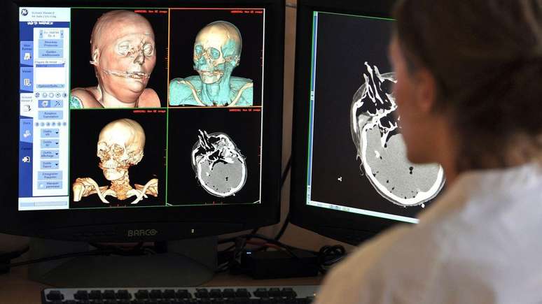 As autópsias virtuais são realizadas com material de exames de imagem como ressonâncias magnéticas